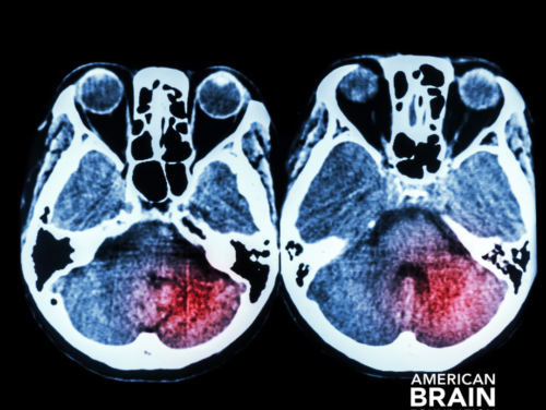 Effects of Stroke - Milka Clarke Stroke Brain Trauma Foundation